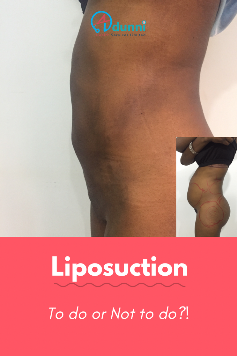 liposuction in kano.