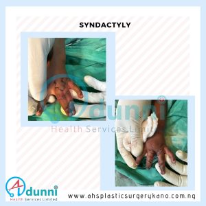 Syndactyly Release