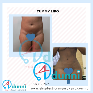 Liposuction Before and after in Kano