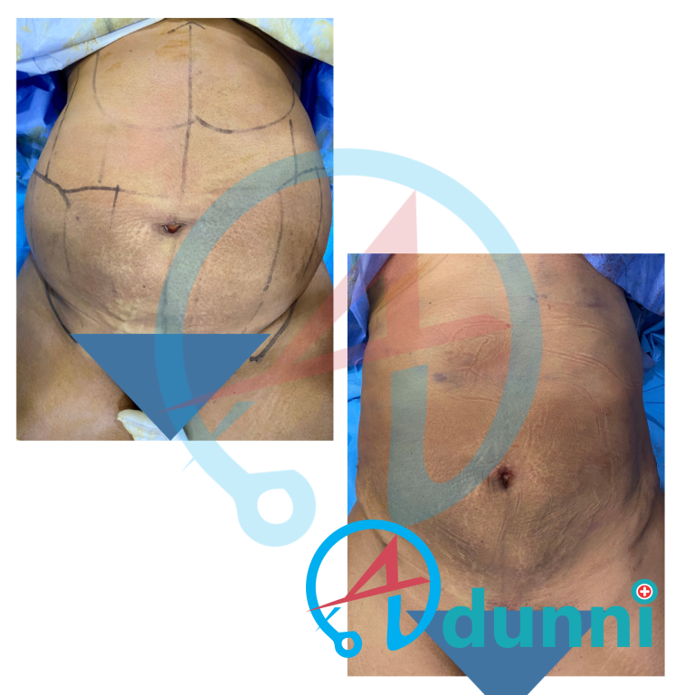 liposuction before and after